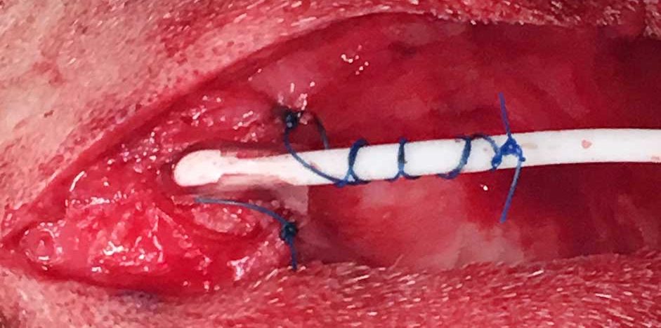 Figure 6. The ventricular portion of the ventriculoperitoneal shunt has been inserted within the lateral ventricle and anchored to the fascia with non-absorbable sutures. A finger-trap suture has also been applied.