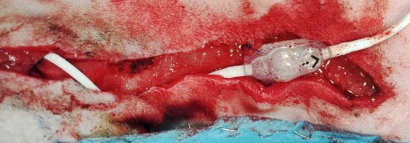 Figure 7. The pressure valve has been placed subcutaneously and anchored to the surrounding soft tissues with non-absorbable sutures.