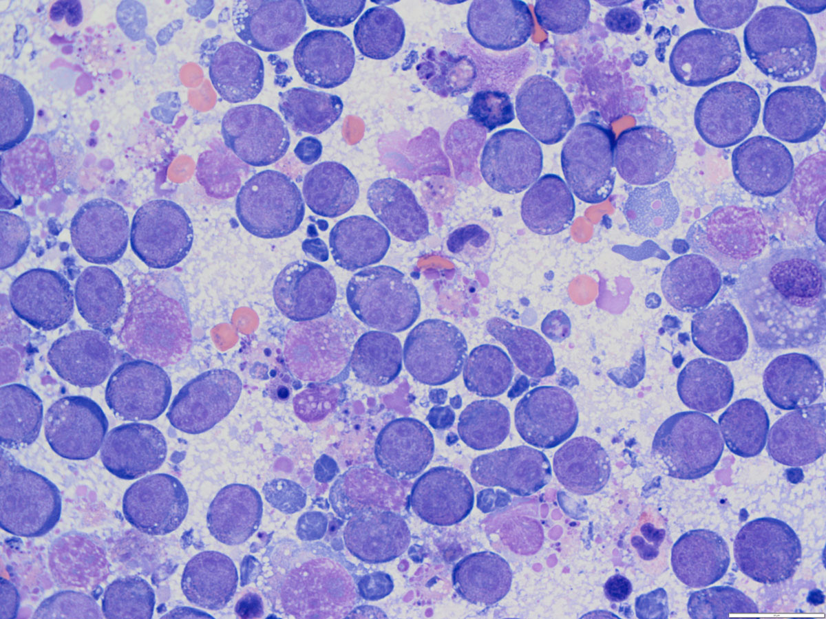 Large cell lymphoma