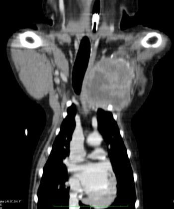 A scan from Harvey’s treatment.