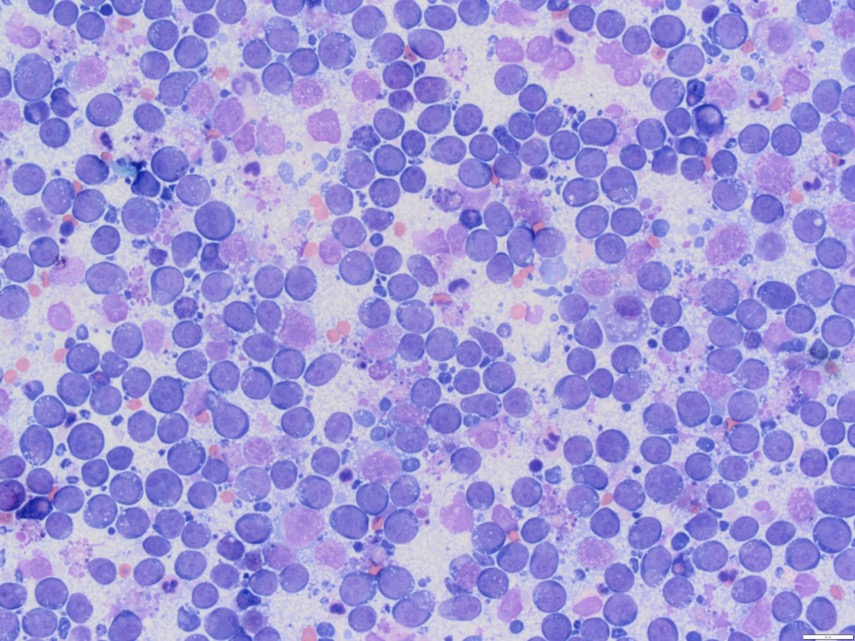 large lymphocytes