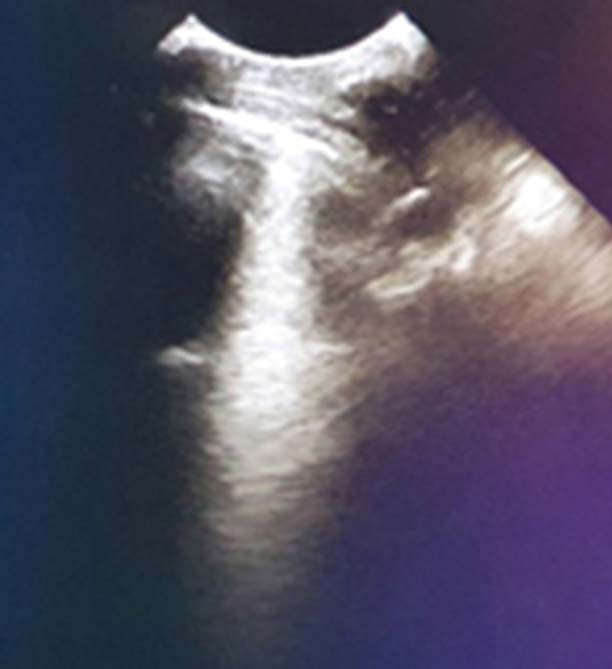  Figure 1. B lines seen on a thoracic point of care ultrasound scan.