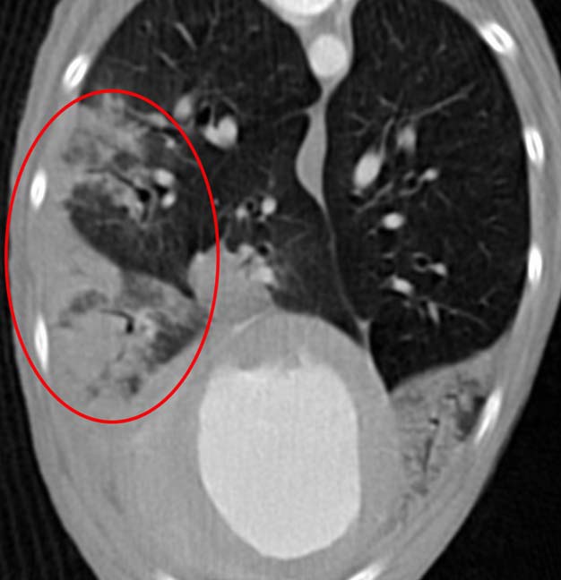 Figure 6. CT scan showing lung lobe torsion.