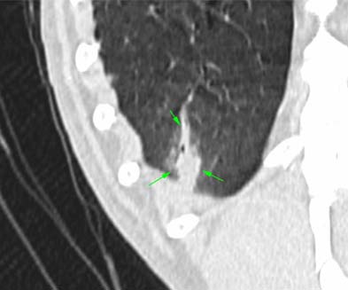  Figure 2. CT scan showing a grass seed lodged in bronchiol.