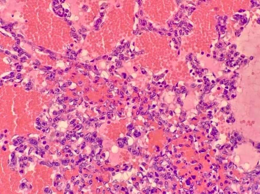 Figure 6. A histopathological view of the splenic haemangiosarcoma. The purple cells are mitotic and neoplastic.