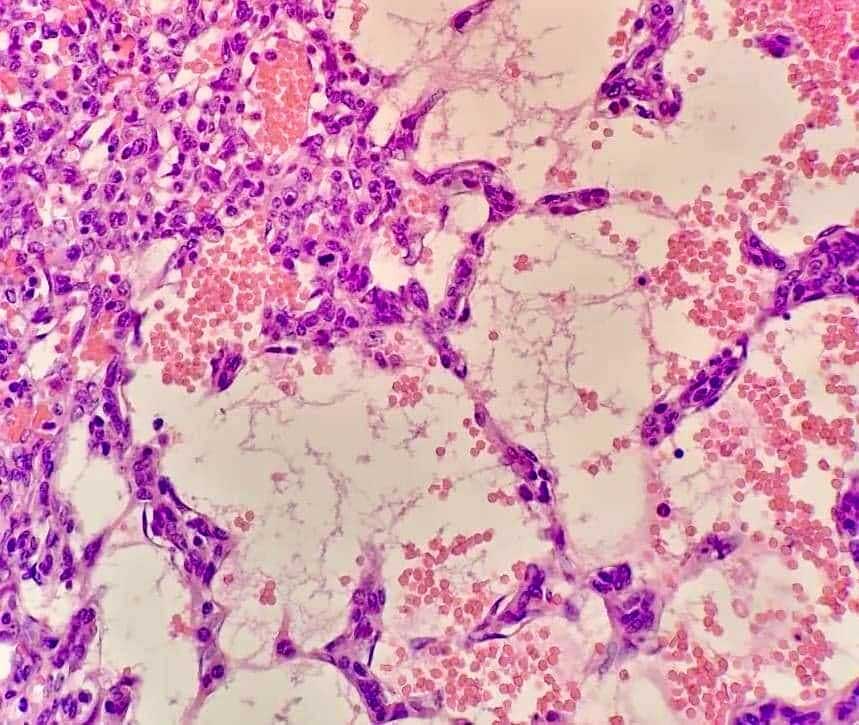 Figure 7. Another histopathological view of the haemangiosarcoma. The purple cells are neoplastic.
