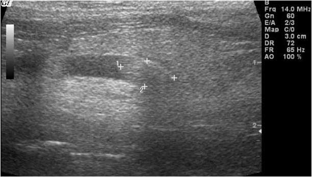 Figure 8. Abdominal ultrasound allows evaluation of changes within kidneys, ureters or bladder. The image shows the presence of a ureterolith with associated hydroureter.