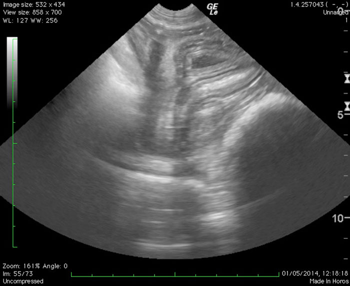 Figure 4. Ultrasound image from the inguinal region of a horse with inflammatory bowel disease. The intramural thickness of the small intestine is increased.