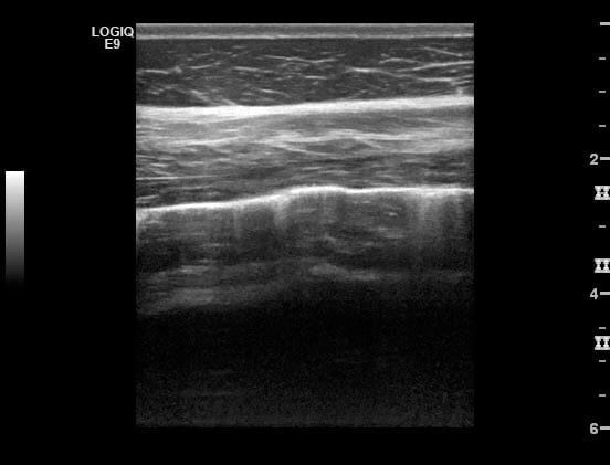 Figure 6. An ultrasonograph of the thoracic cavity from a horse with interstitial pneumonia. Note the bright hyperechoic line indicating the interface between the visceral and parietal pleural surfaces. Some irregularity of the pleural surface gives rise to “comet tails”. Movement of this bright line during normal respiration (gliding lung sign) confirms it is the lung surface, rather than free air in the pleural space, which is being imaged.