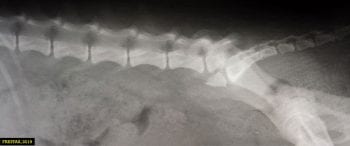 Figure 2. L7-S1 fracture with ventral dislocation of S1 in relation to S7.