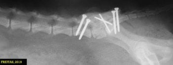 Figure 3. Screws/pins and bone cement stabilisation for L7-S1 fracture. Note the screws should pass the trans cortex 1mm to 2mm. The picture shows three out of the four screws passed over this margin; however, complications are rare.