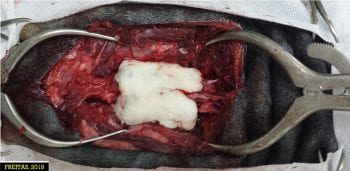 Figure 4. Surgical view of L7-S1 fracture stabilisation using screws/pins and bone cement.