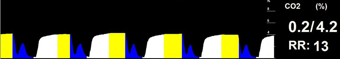 Figure 10. The colour-coded capnogram for the patient in Figure 6.