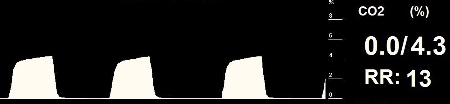 Figure 3. A typical capnogram under spontaneous breathing.