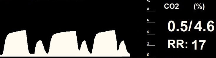 Figure 6. A capnogram with a small secondary rise in CO2 after the main trace.