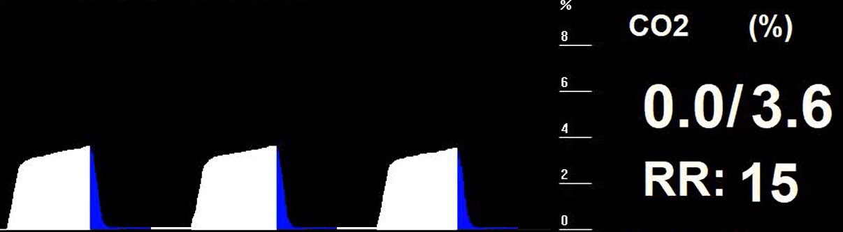 Figure 7. The colour-coded capnogram for the patient in Figure 3.