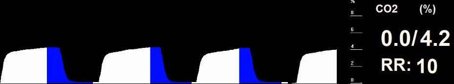 Figure 8. The colour-coded capnogram for the patient in Figure 4.