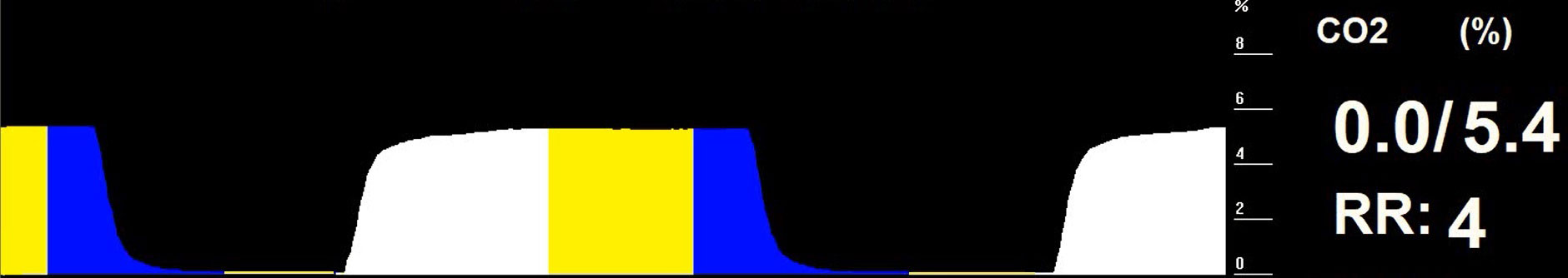 Figure 9. The colour-coded capnogram for the patient in Figure 5.