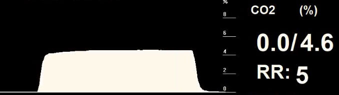 Figure 5. A typical capnogram from a patient on a circle circuit with an expiratory pause.