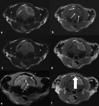 Figure 2. Transverse images of the extra-axial lesion at the level of the mesencephalon. (a) The lesion appeared markedly heterogeneously hyperintense compared to grey matter in T2-weighted images. (b) Hypo-isointense compared to grey matter in T1-weighted images; the thin arrows delineate the lesion. (c) T2-FLAIR images allowed to differentiate secondary effects (mainly oedema). (d) T1-weighted images post-contrast showed mild heterogenous enhancement and marked peripheral enhancement. (e) T2-gradient echo images were used to visualise haemorrhage. The haemorrhages appeared black on these images and are indicated by the dashed arrows. (f) T1-weighted post-contrast image at the level of the rostral colliculus showed dural tail indicated by thick arrow.