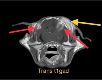 Kisha's CT scan showing the brain abcess.