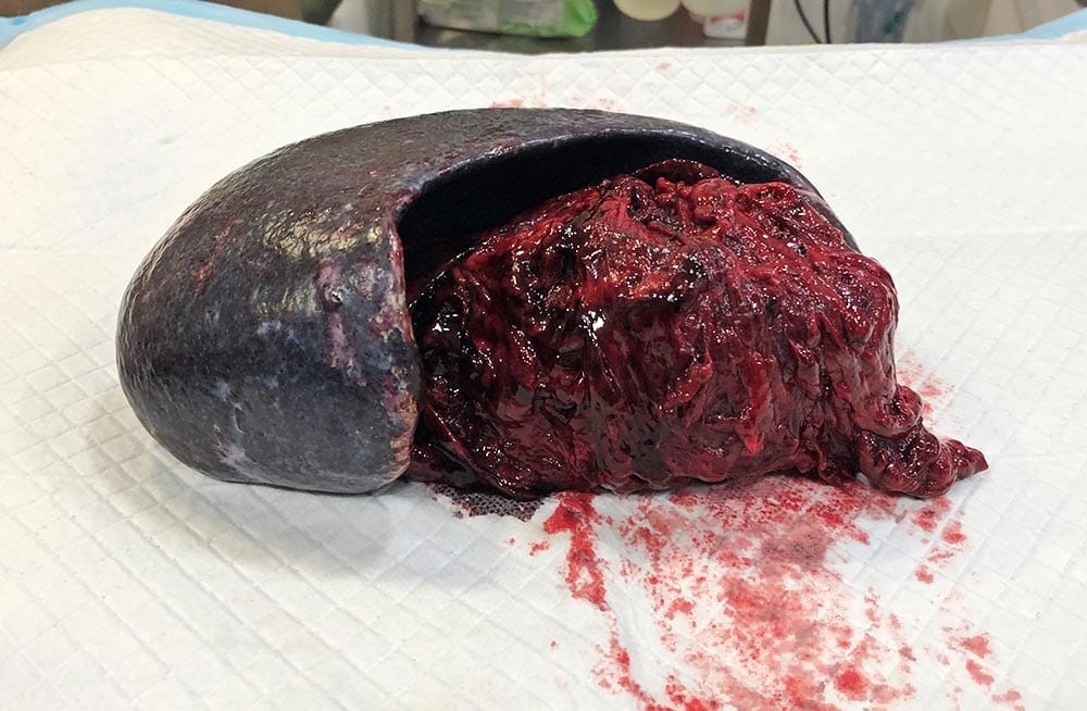 Gus’ removed spleen.