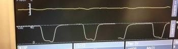 Figure 4 The capnograph trace should return to baseline to indicate that inspired carbon dioxide tension is zero or close to zero and no rebreathing of carbon dioxide is occurring.