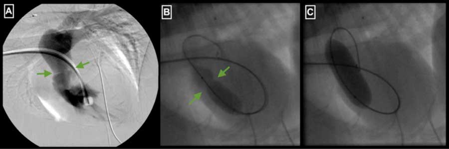 Figure 2. Fluoroscopic images from Toby’s balloon valvuloplasty. (A) Contrast is administered via a catheter located in the right ventricle, which reveals the position of the fused valve leaflets (arrows). (B) A partially inflated balloon catheter is seen positioned at the level of the stenosis (arrows). (C) The balloon catheter is fully dilated resulting in stretching of the stenotic area. 