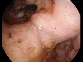 Figure 3. A gastroscopic image of a seven-year-old Jack Russell terrier with chronic vomiting. The incisura is markedly thickened. Biopsies revealed a gastric adenocarcinoma.