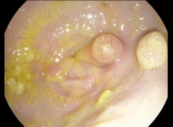 Figure 6. A gastroscopy image of a 13-year-old Labrador retriever where a suspected gastric mass had accidentally been detected on ultrasonography. Irregular mucosal surface with a multifocal small (approximately 0.5cm) oval/round raised lesion and two larger (approximately 1cm to 1.5cm) masses at the level of the pylorus and pyloric antrum. Biopsies showed hyperplastic mucosa and gastric polyps were diagnosed.