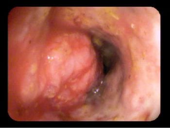 Figure 4. A colonoscopic image of an 11-year-old labradoodle with tenesmus. Biopsies of the mass revealed an adenocarcinoma.