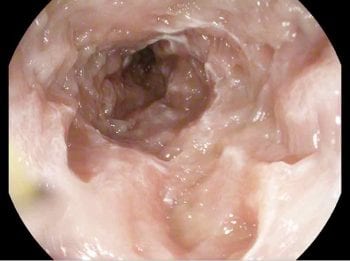 Figure 5. An endoscopic picture of the duodenum of an eight-year-old pug undergoing investigations for hypoalbuminaemia without any other clinical signs. The mucosa is very irregular and suspected leakage of lymph exists. The mucosa was very friable. Biopsies revealed lymphoplasmacytic inflammation.