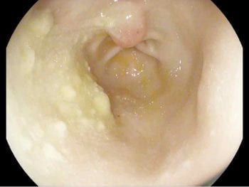 Figure 7. A gastroscopy image of an eight-year-old pug with hypoalbuminaemia, but no other signs. A large round mass was observed in close proximity to the pylorus. Biopsies of the mass revealed lymphoplasmacytic inflammation.