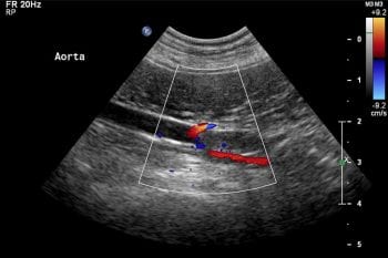 Figure 8. An ultrasonographic image of a nine-year-old pug with acute onset paraparesis. An echogenic structure is present within the terminal aorta measuring. Investigations concluded hypocobalaminaemia and protein-losing enteropathy.