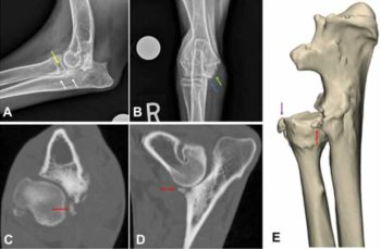 Figure 2. Lateral projection of the left and right shoulders of a six-month-old female border collie that presented with a one-month history of right shifting forelimb lameness. Flattening of subchondral bone of the caudal aspect of the humeral head can be appreciated on both views (white arrows), but more markedly on the right.