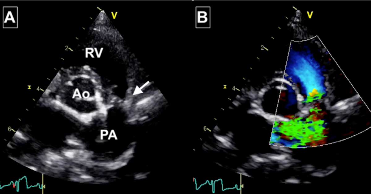 Figure 1. Images from Toby’s echocardiogram. (A) The arrow points at the stenotic lesion and shown fused thin valve leaflets. Post-stenotic dilation of the main pulmonic artery is evident distal to the valve. Abbreviations: Ao = aorta, PA = pulmonary artery, RV = right ventricle. (B) The colour Doppler image shows turbulence (green) originating from the fused valve, explaining the audible heart murmur.