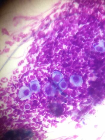 A photomicrograph of a typical cytological finding in cases of Pemphigus foliaceus. Numerous neutrophils, more or less degenerate, and several acantholytic cells can be seen.