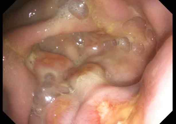 Figure 3. Fibrinosuppurative lesions of the glandular mucosa are one manifestation of equine glandular gastric disease.