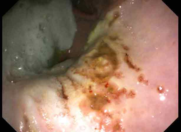 Figure 2. Equine squamous gastric disease in an endurance horse.
