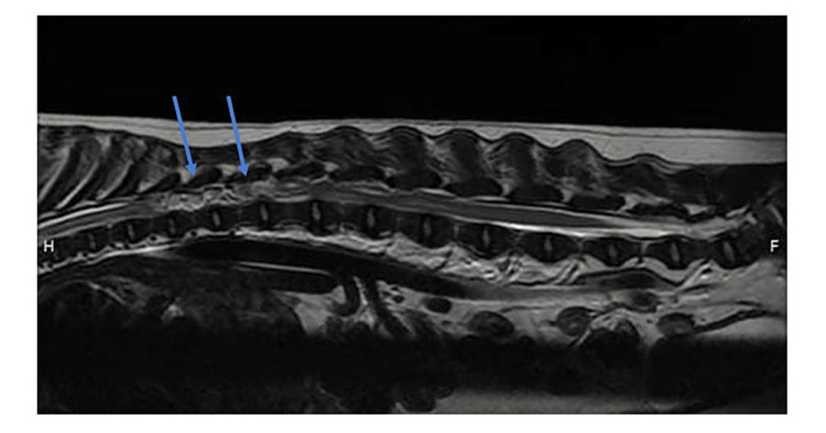 Figure 1. MRI scan showing extradural compressing lesion (arrow).