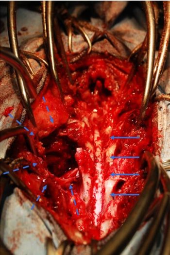 Figure 3. Following extensive dorsal laminectomy the purulent material was retrieved; the spinal cord is visible in the neural canal (solid arrows). The paralumbar musculature was dissected from the left side of the vertebral column (dotted arrows), allowing exploration of the sublumbar region and retrieval of further purulent material. 