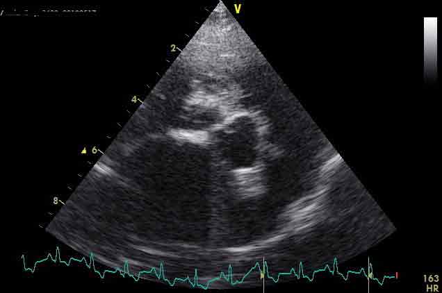 Figure 3a. Left atrial:aortic ratio.