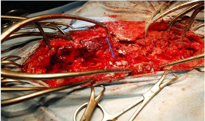 Figure 2. Surgical site following dorsal laminectomy. Purulent material can be seen coming from the spinal canal (arrow).