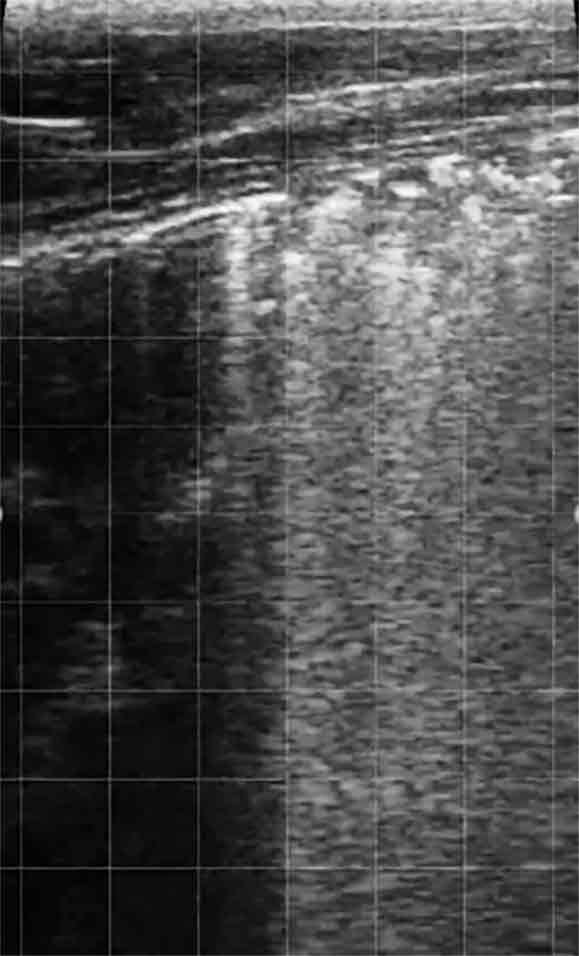 Figure 1.. Thoracic ultrasound image of a calf showing areas of consolidation, consistent with bovine respiratory disease.