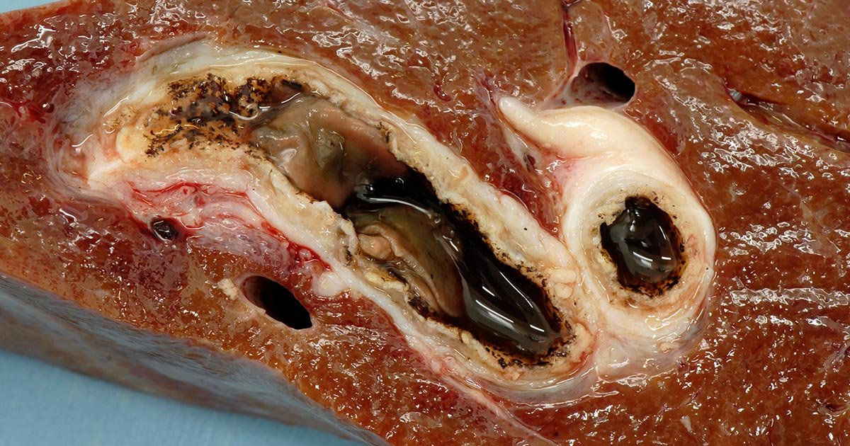 Figure 1. A cross-section of bovine liver showing adult liver fluke (Fasciola hepatica), and fibrosed and calcified bile ducts