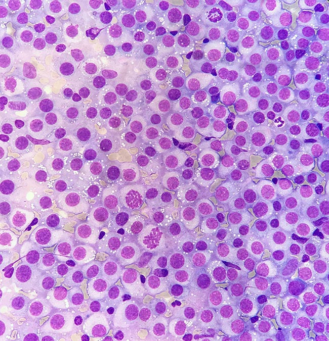 Figure 2. Fine needle aspirate from a vaginal mass showing discrete round cells with abundant pale cytoplasm that often contains small, clear, punctate vacuoles, and a round nucleus with coarsely stippled chromatin and often a large, indistinct nucleolus. Three mitotic figures are present. Rare neutrophils and small lymphocytes are also present. Modified Wright-Giemsa stain. Original magnification × 500 objective. Image © Anne Aworinde