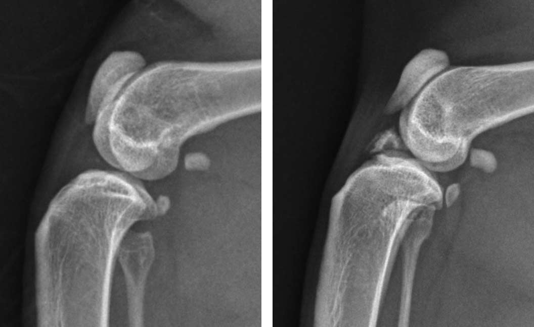 Figure 7. Mediolateral radiographs of the left stifle of two different cats. Note the small, rounded area of mineralisation in the cranial aspect of the joint in the radiograph on the left, which is likely physiological. In comparison, the mineralisation in the cranial aspect of the joint in the radiograph on the right is more irregular in shape and much larger, rendering it likely to be pathological.