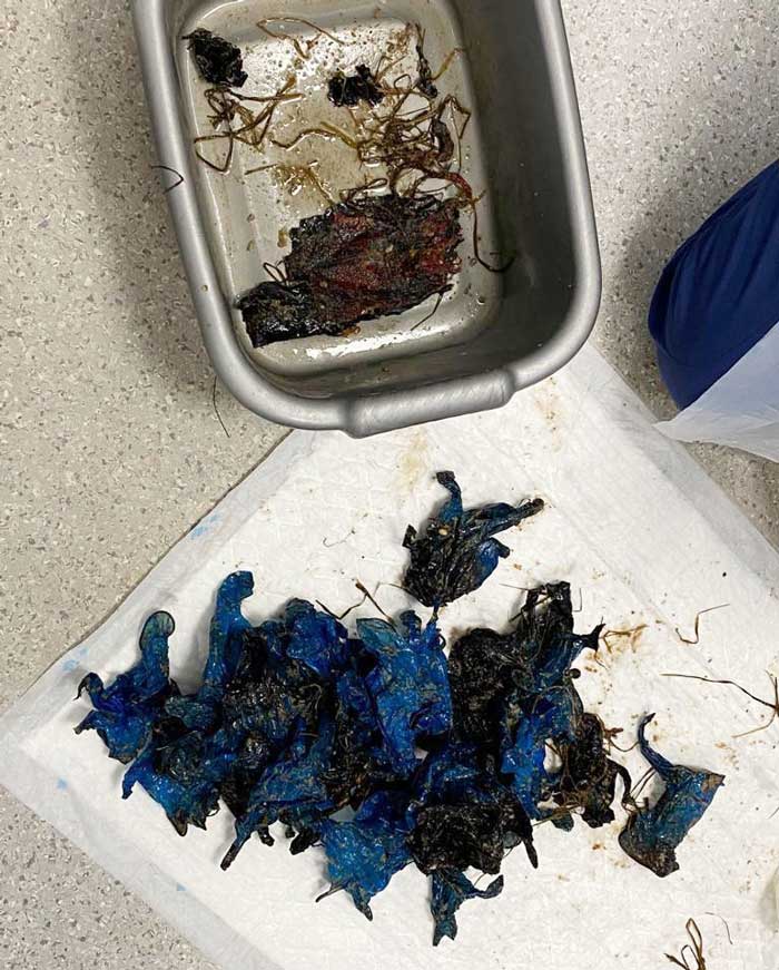 Three hours later, all of the gloves (29) are removed from Rambo's stomach.