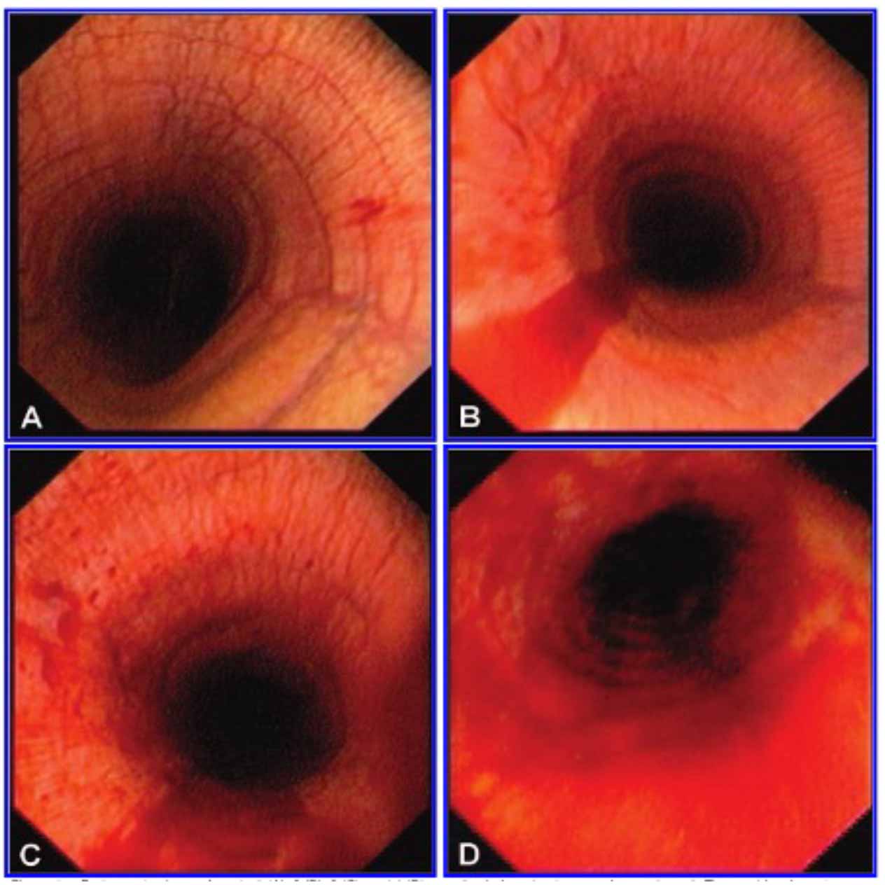 Figure 1. Endoscopic views of grades 1 to 4 (A to D, respectively) adapted directly from Hinchcliff et al26.