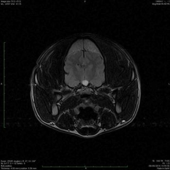 Figure 3c. Transverse images of the brain: flair.